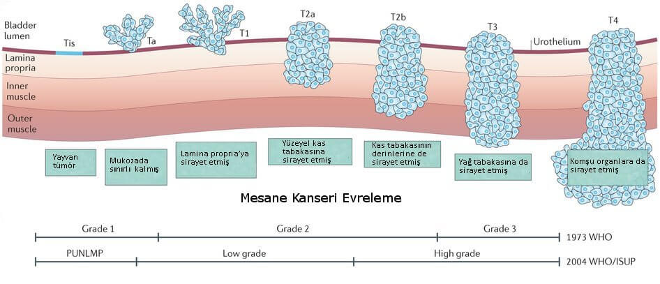 mesane kanseri evreleme