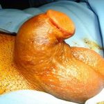 penis uzatma ameliyat öncesi