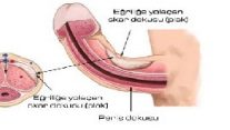 Eğri Penis ve Peyronie Hastalığı