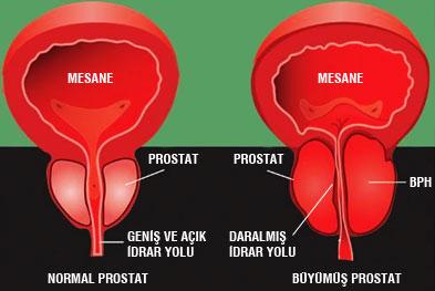 prostat büyümesi