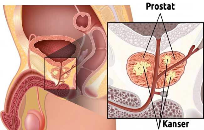 cum se determină cauza prostatitei cronice tratament infecție urinara