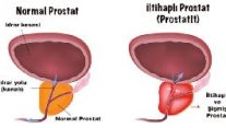 Prostatit miyim?
